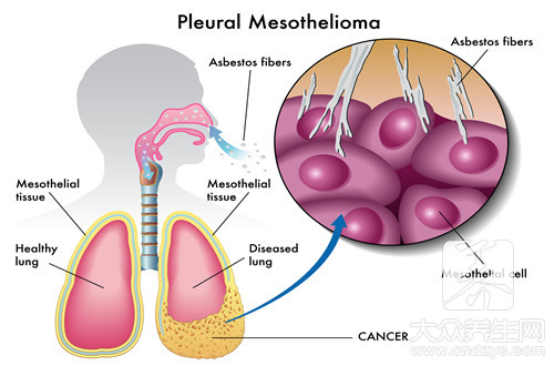 老人气喘胸闷的原因